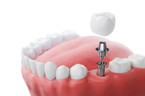 implantation dentaire, dents avec vis implantaire, illustration 3d. - implant photos et images de collection