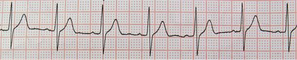 istock Panoramic shot of an electrocardiogram with interesting patterns 1439461565