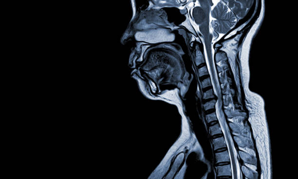 mri (1.5 tesla) of the cervical spine was performed by sagittal t1w moderate spinal cord compression at c5-6 (6 mm in ap) with myelopathy . - menselijke nek stockfoto's en -beelden