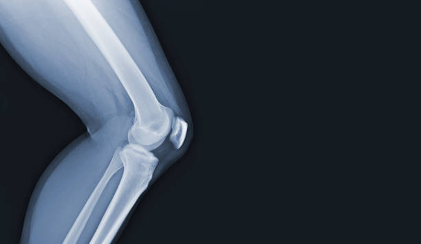 人間の膝の正常な関節と靭帯のフィルムx線医療画像のコンセプト。 - cartilage patella human knee medical exam ストックフォトと画像