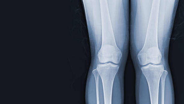 bande dessinée du genou humain à la fois le genou debout vues normales articulations et ligaments concept d’image médicale. - x ray human knee orthopedic equipment human bone photos et images de collection