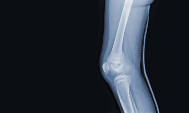radiographie du genou humain montrant une fracture fermée, un fémur distal droit, des articulations et des ligaments normaux concept d’image médicale. - x ray human knee orthopedic equipment human bone photos et images de collection