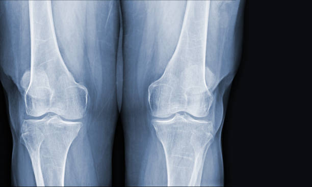 人間の膝の正常な関節と靭帯のフィルムx線医療画像のコンセプト。 - cartilage patella human knee medical exam ストックフォトと画像