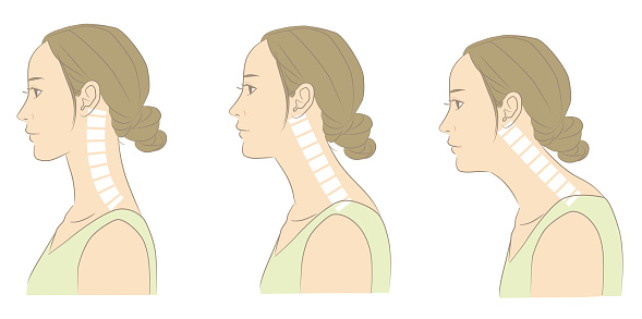 Woman With Normal Cervical Spine And Straight Neck Stock