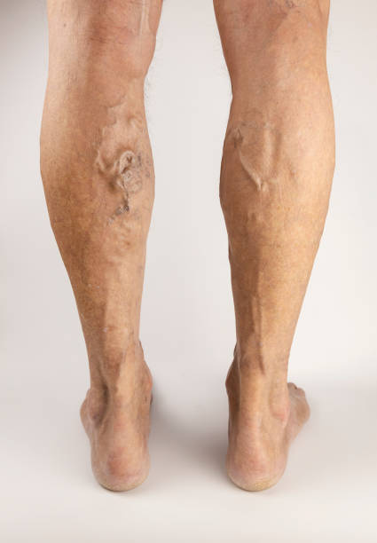 варикозное расширение вен на мужских ногах. лечение варикозного расширения вен. - animal vein стоковые фото и изображения
