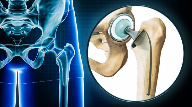 Femoral head hip prosthesis or implant x-ray with magnification or close-up. Total hip joint replacement surgery or arthroplasty 3D rendering illustration. Medical and healthcare, science concepts. stock photo