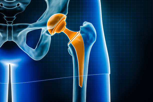 Hip prosthesis x-ray 3D rendering illustration. Total hip joint replacement surgery or arthroplasty, medical and healthcare, arthritis, pathology, science, osteology, orthopedics concepts. stock photo