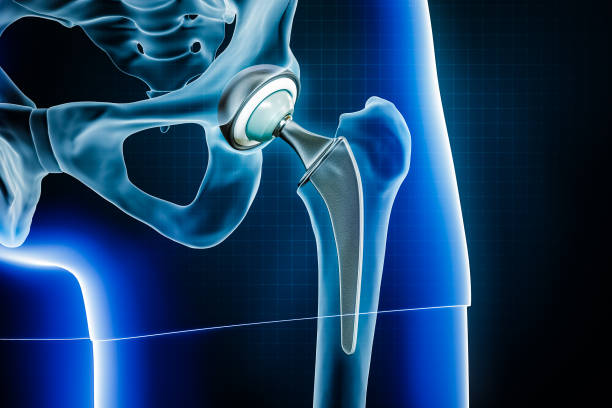 Femoral head hip prosthesis or implant. Total hip joint replacement surgery or arthroplasty 3D rendering illustration. Medical and healthcare, arthritis, pathology, science, osteology concepts. stock photo