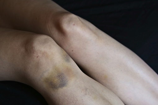A large bruise on a woman's leg. Violence against women concept image.