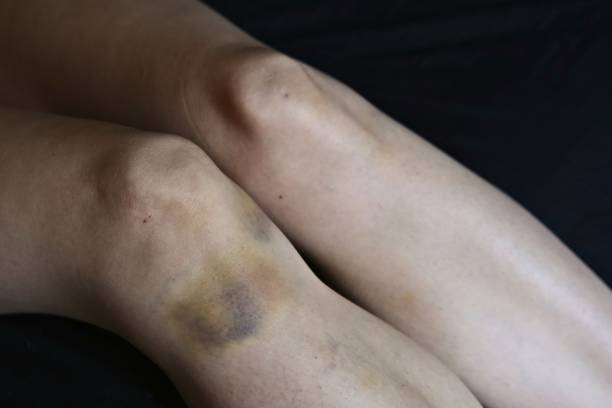 a large bruise on a woman's leg. violence against women concept - violence domestic violence victim women imagens e fotografias de stock