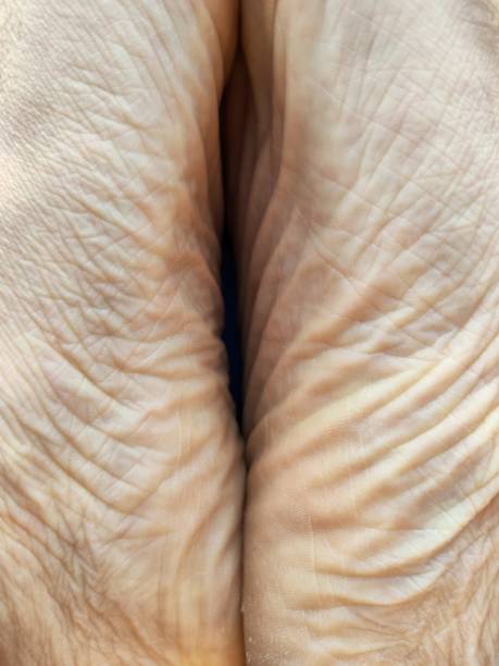 istock Feet skin 1439814153