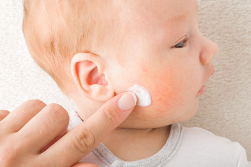 Young adult mother finger applying white medical ointment on newborn boy cheek. Red rash on skin. Allergy from milk formula or mother milk. Care about baby body. Closeup. Top down view.