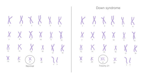 das chromosom 21 ändert die kopiennummer von normal (2 kopien) zu abnormalen (extra) chromosom (3 kopien), die trisomie 21: down-syndrom nennen - chromatid stock-grafiken, -clipart, -cartoons und -symbole