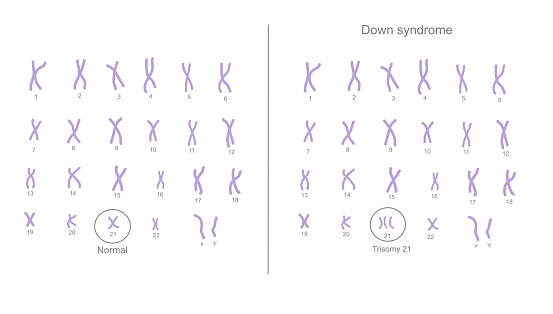 The chromosome 21 are changed the copy number from normal (2 copies) to abnormal (extra) chromosome (3 copies) that call Trisomy 21: Down syndrome