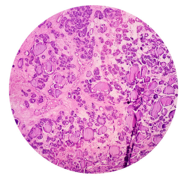 istock Follicular adenoma of thyroid gland, light micrograph. Histopathology of thydoid adenoma. Photo under microscope show thyroid tissue. 1439918236