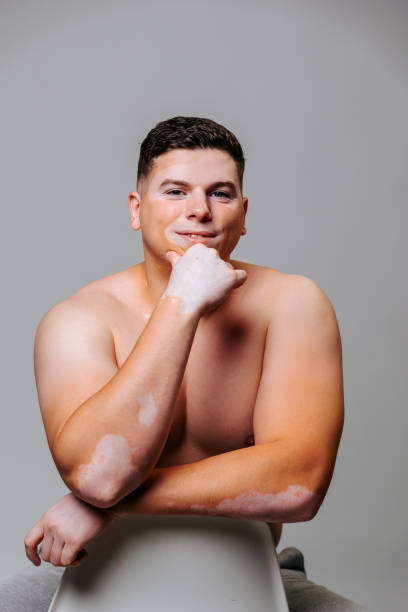 istock Front view looking at the camera a young man with vitiligo props his chin with one hand, smiles. 1439927873