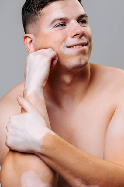istock Young man symmetrical skin pigmentation portrait gray studio background smile one hand props up chin 1439927909