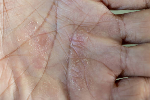 close up dry, peeling hands stock photo