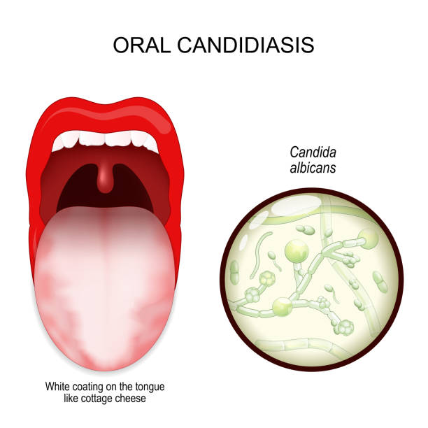 illustrations, cliparts, dessins animés et icônes de candidose buccale. muguet buccal infection à levures. - thrush yeast fungus illness