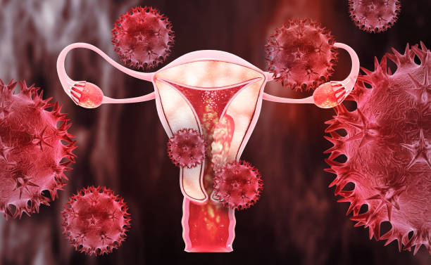 câncer de útero ou útero. conceito médico como células cancerígenas se espalhando em um sistema reprodutivo feminino. ilustração 3d - ovário - fotografias e filmes do acervo