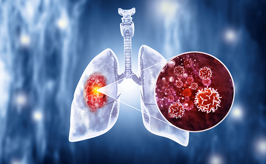 Medical Illustration showing lung cancer or bronchial carcinoma. 3d illustration