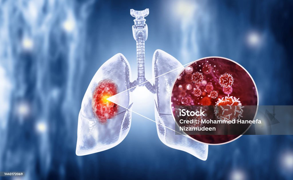 Medical Illustration showing lung cancer or bronchial carcinoma. 3d illustration Lung Cancer Stock Photo