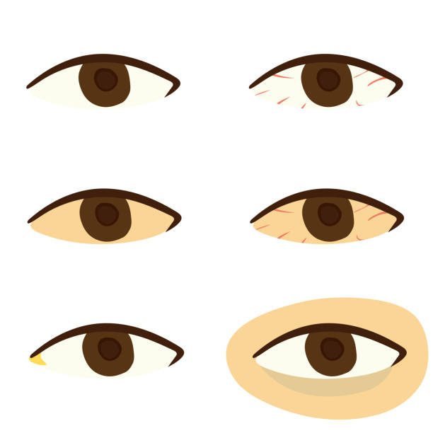 Eye Problem Graphicsgraphics 100+ Eye Redness Stock Illustrations, Royalty-Free Vector Graphics ...