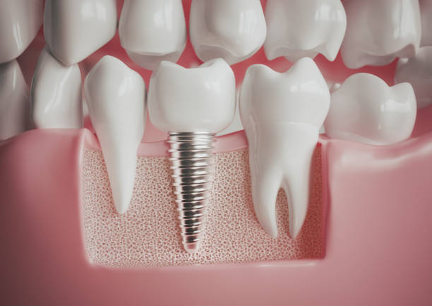 Implant next to a healthy molar - 3D rendering Implant next to a healthy molar -- 3D rendering dental implant stock pictures, royalty-free photos & images