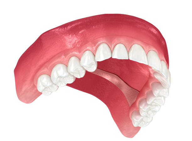 istock Maxillary prosthesis with gum All on 6 system supported by implants. Dental 3D illustration 1440239825