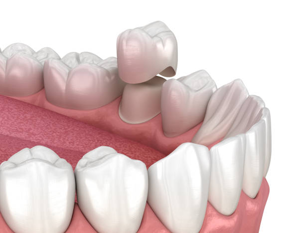 istock Preparated premolar tooth and dental crown placement. Medically accurate 3D illustration 1440239889
