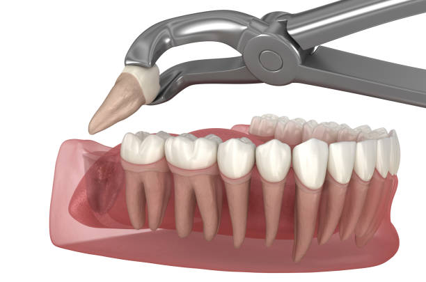 extraction of wisdom tooth. medically accurate tooth 3d illustration. - druppelfles stockfoto's en -beelden