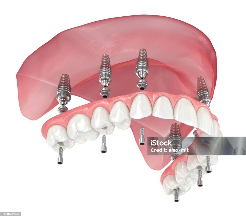Maxillary Prosthesis Maxillary Prosthesis With Gum All On 6 System Supported By Implants ...
