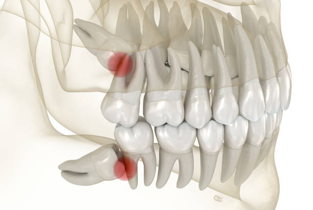 mesial impaction of wisdom teeth. medically accurate tooth 3d illustration - siso imagens e fotografias de stock