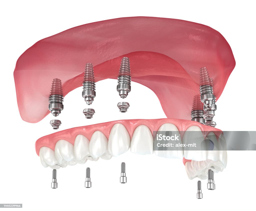 Maxillary Prosthesis Maxillary Prosthesis With Gum All On 6 System Supported By Implants ...