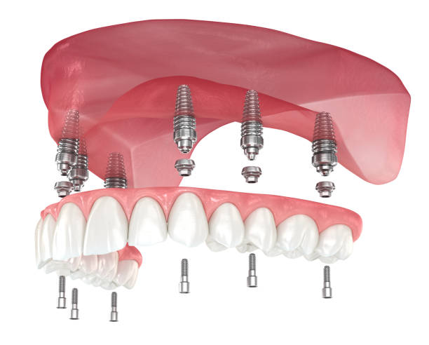 maxillary prosthesis with gum all on 6 system supported by implants. dental 3d illustration - implantat imagens e fotografias de stock