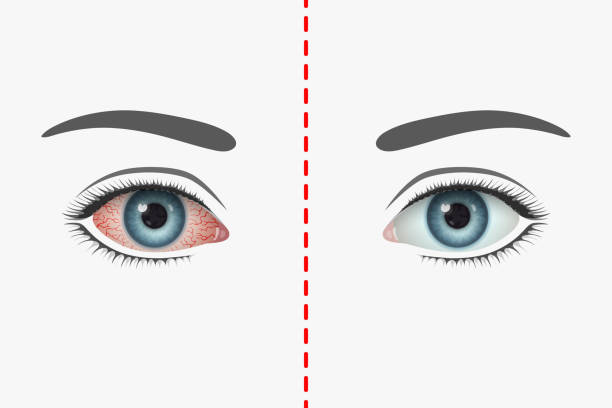 Reddened unhealthy human eye with many blood vessels and healthy eye - ilustração de arte vetorial