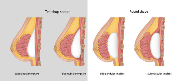 Subglandular and Submuscular Breast Implants. Implant shapes Teardrop shape and Round shape. Breast implant types. Subglandular and Submuscular Breast Implants. Breast implant shapes Teardrop shape and Round shape. Breast implant types. silicone implants stock illustrations