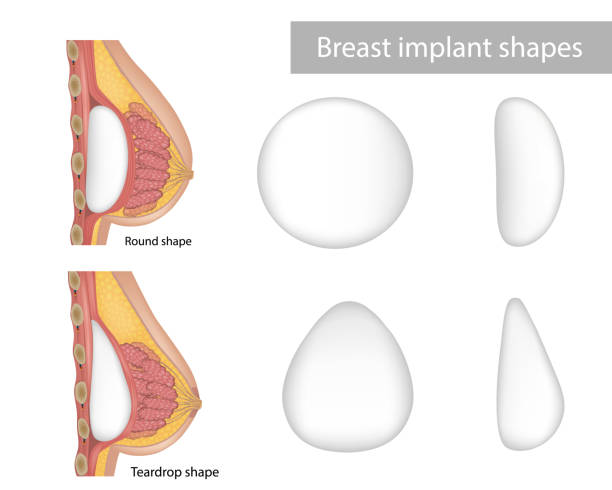 kształty implantów piersi kształt łzy i kształt okrągły. chirurgia plastyczna. wynik poprawy biustu, klatka piersiowa kobiety po operacji plastycznej. - silicone stock illustrations