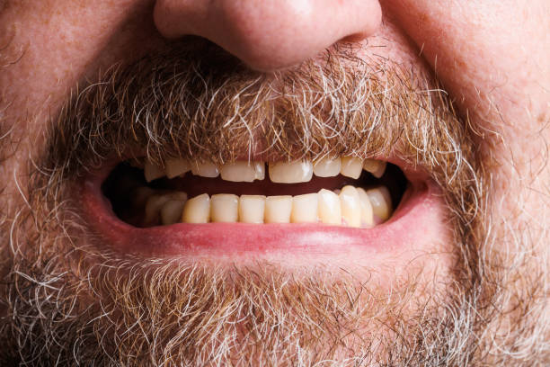 istock Close up image of unperfect male grin teeth. 1440766049