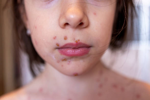 istock A girl with chicken pox 1440810878