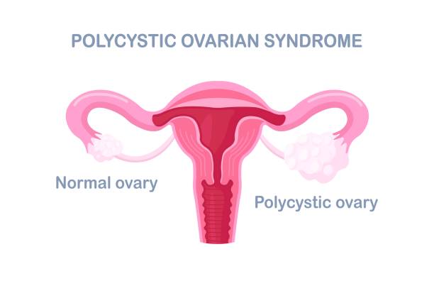 Polycystic ovary syndrome. PCOS hormonal diagnose. Female reproductive system with ovary, uterus, fallopian tubes. Female organs disease vector art illustration