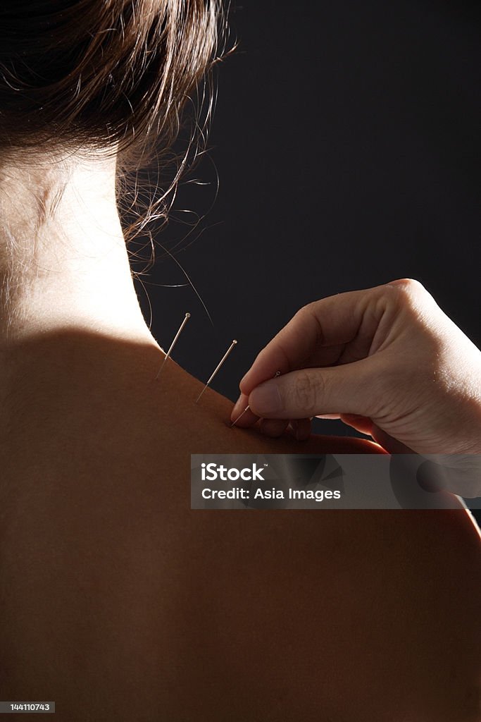Terapista aplicando acupuntura agulhas de Mulher's neck - Foto de stock de Acupuntura royalty-free