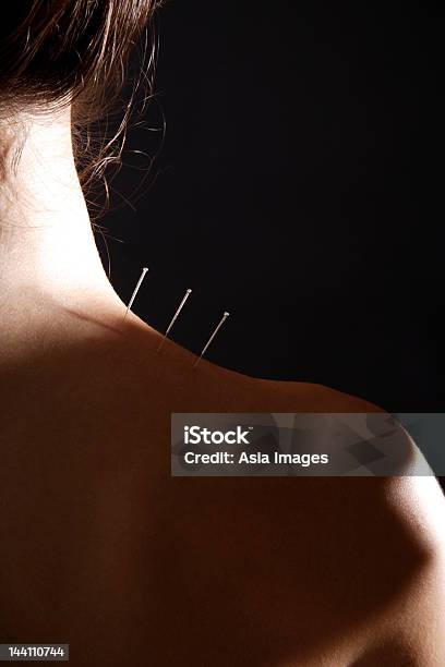 Akupunktura Igły W Kobietas Neck - zdjęcia stockowe i więcej obrazów 25-29 lat - 25-29 lat, Akupunktura, Bez koszulki