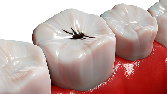 Tooth damaged by caries, close-up. Human jaw, 3d render. Medically accurate dental 3D illustration