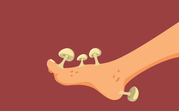 Foot with Fungus Problem Concept Cartoon Illustration Person dealing with mycosis and tinea pedis skin problems tinea stock illustrations