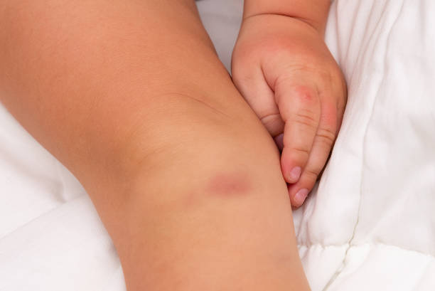 istock Big bruise on baby's knee 1441589084
