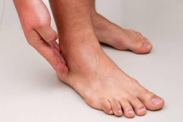 istock swollen leg after ankle sprain 1441589093