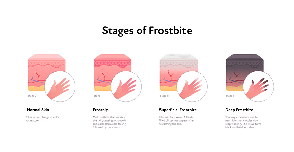 Frostbite anatomical infographic. Vector flat healthcare illustration. Stages of hypothermia. Skin layers and hand with finger healthy, frostnip, superficial and deep stage. Design for dermatology