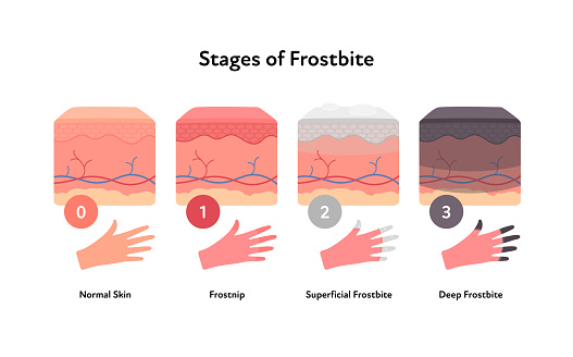 Frostbite anatomical infographic. Vector flat healthcare illustration. Stages of hypothermia and windburn. Skin layers and hand with fingers and stage number. Design for dermatology