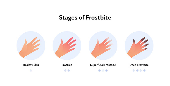 Forstbite Chart Frostbite Anatomical Infographic Poster Vector Flat Medical ...